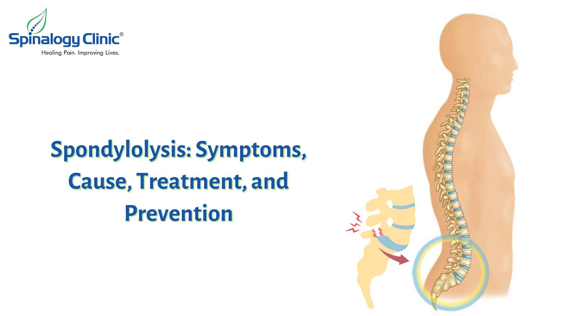 Spondylolysis: Symptoms, Cause, Treatment, and Prevention